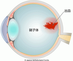 硝子体出血のイメージ 　出典　日本眼科学会　目の病気