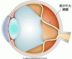 牽引性網膜剥離のイメージ 出典　日本眼科学会　目の病気