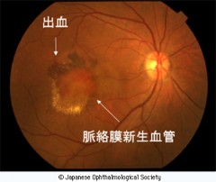眼底写真でみる網膜の出血 （滋賀医科大学眼科　大路正人教授提供） 出典　日本眼科学会　目の病気