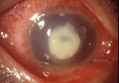 緑膿菌角膜潰瘍 角膜上皮のキズから細菌やカビなどが侵入して感染し、潰瘍を生じます。 治りにくく治っても混濁や視力障害が残る場合が多いので、十分な注意が必要です。角膜中央が潰瘍（出典　日本コンタクト協会　コンタクトレンズによる目の病気）