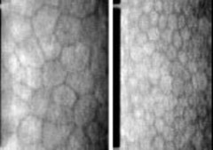 角膜内皮障害 長年のレンズ装用による酸素不足などにより、 角膜の内皮細胞が代謝障害で脱落し大きく変形したりします。 内皮細胞は再生しないので、細胞数がある程度以下に減少すると、 角膜が混濁したりする障害を生じます。(角膜内皮:角膜の内側(目の中の側)の表層)左:内皮障害/右:正常 (出典 日本コンタクトレンズ協会 コンタクトレンズによる目の病気)