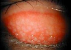巨大乳頭結膜炎 レンズの汚れによるアレルギーで、上瞼(上のまぶた)の裏側にある結膜が炎症を起こして充血し、ぶつぶつした乳頭ができます。かゆみがあり、目ヤニが出てレンズの装用に影響します。上まぶたをうら返したところ。 白い石垣状が巨大乳頭 (出典 日本コンタクトレンズ協会 コンタクトレンズによる目の病気)